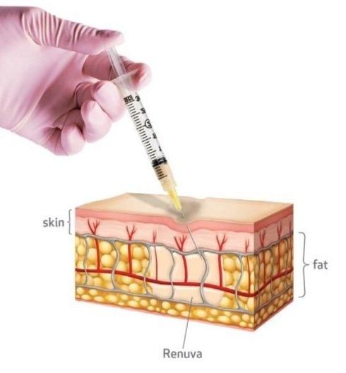 Injection into skin and fat layer illustration.