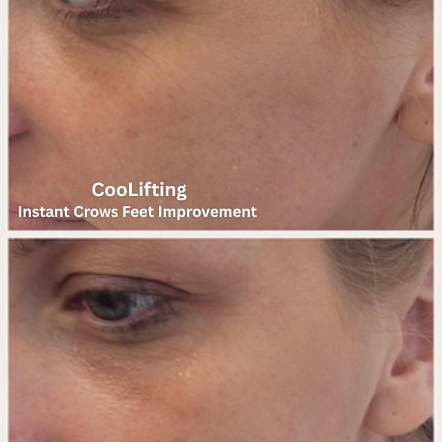 Cool Lifting Before & After