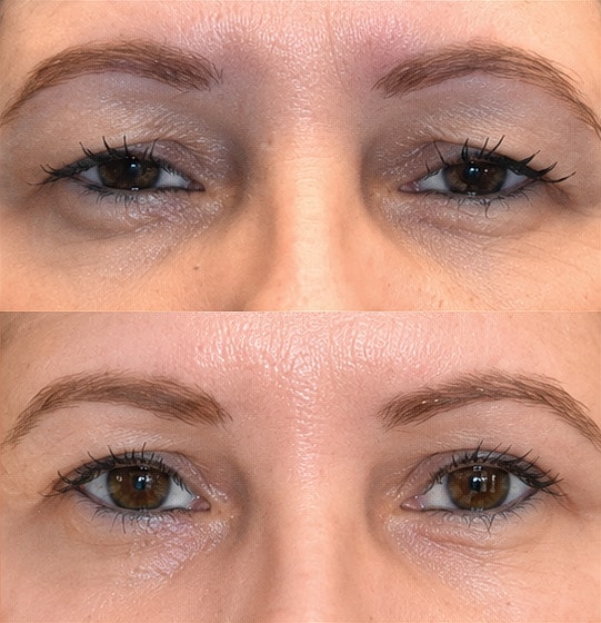 ZipLyft™ Before & After