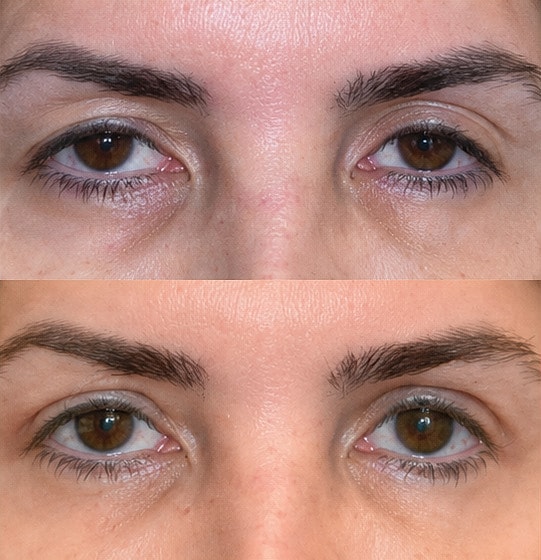 ZipLyft™ Before & After