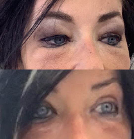 ZipLyft™ Before & After