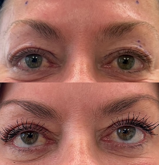 ZipLyft™ Before & After