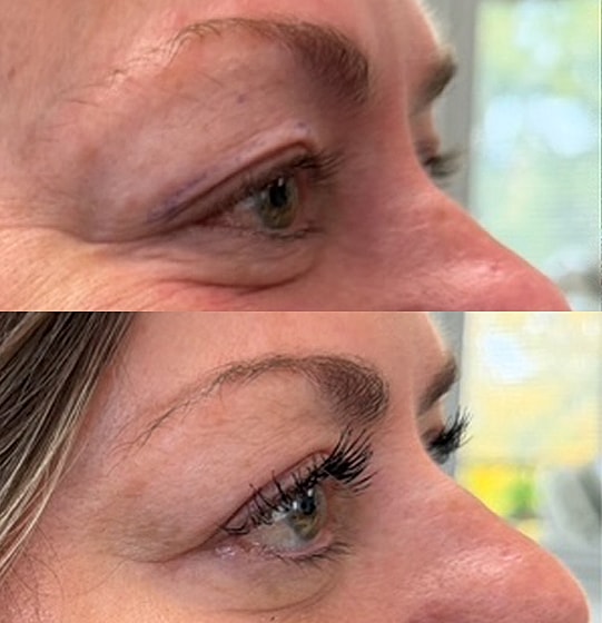 ZipLyft™ Before & After