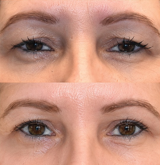 ZipLyft™ Before & After