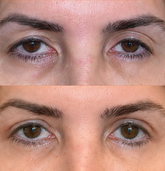 ZipLyft™ Before & After