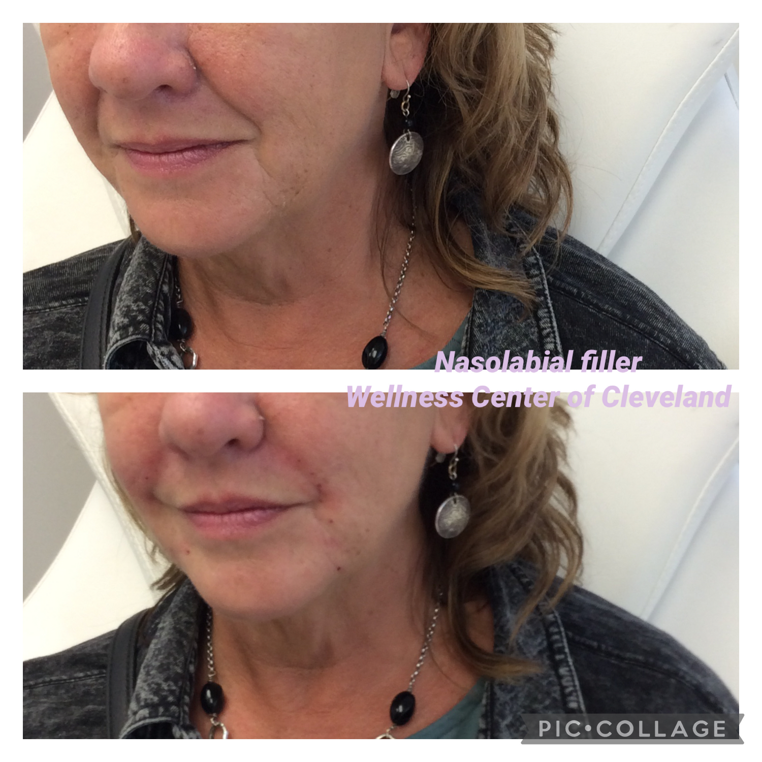 Dermal Filler Before & After