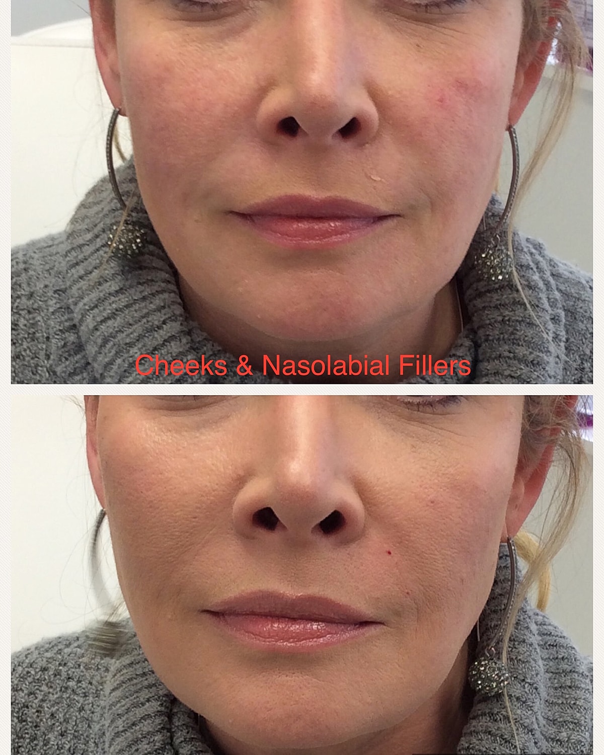 Nasolabial Folds Filler Before & After