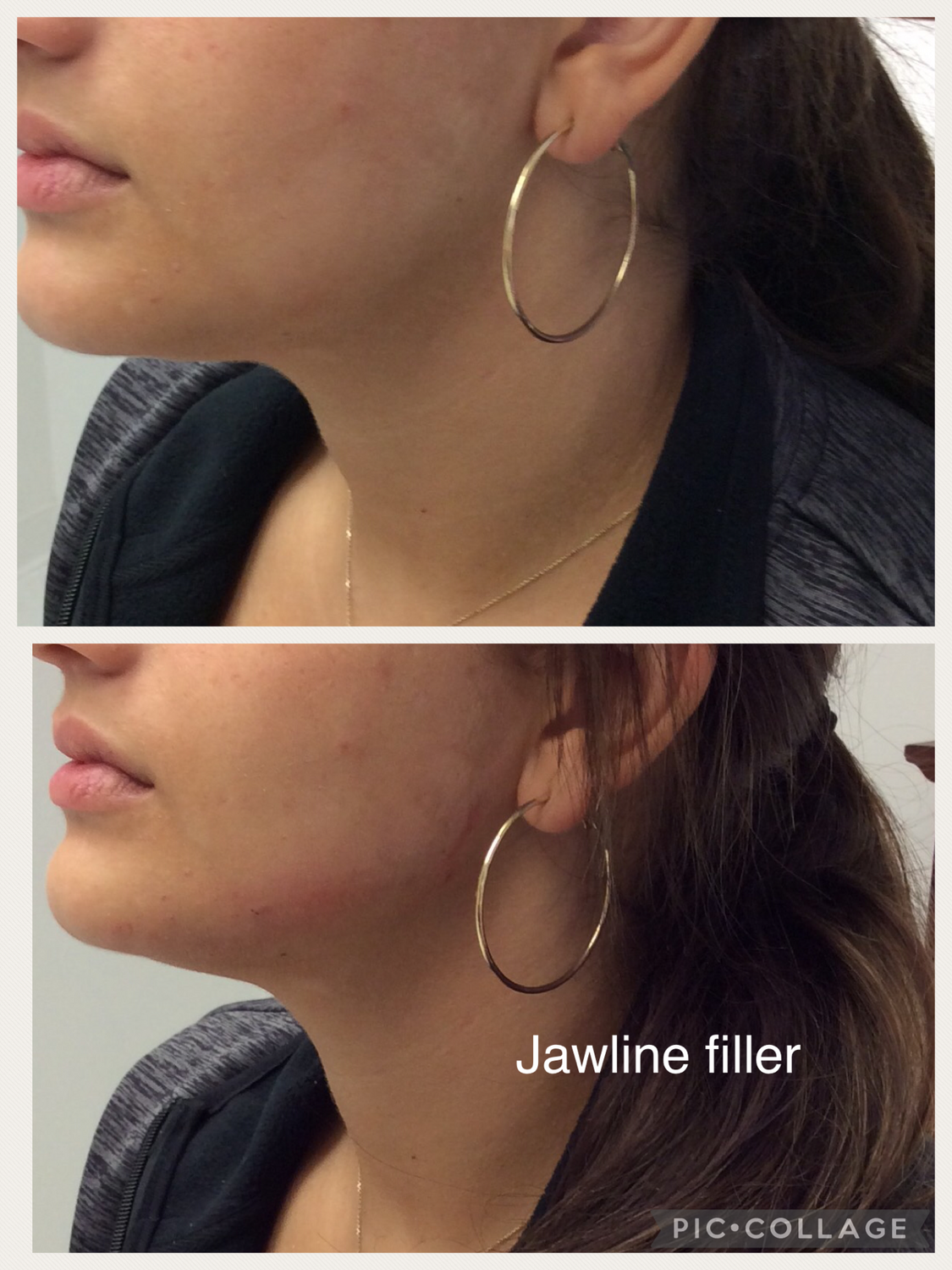 Jawline Filler Before & After