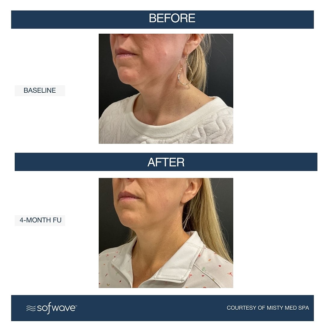 Laser & Energy Before & After