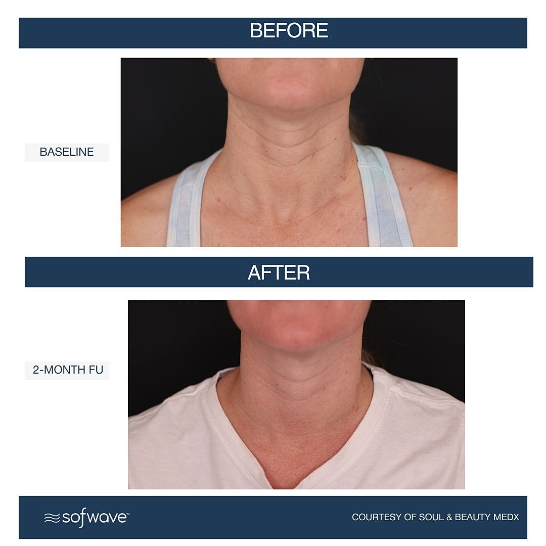 Laser & Energy Before & After