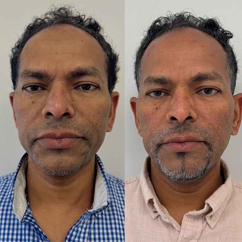 Laser & Energy Before & After