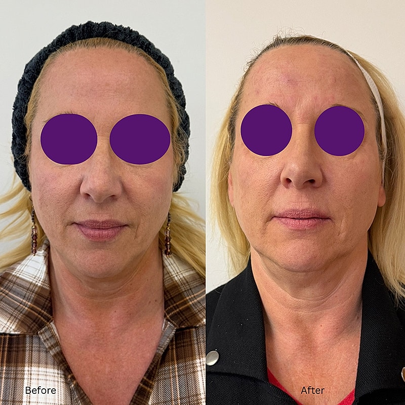 Laser & Energy Before & After