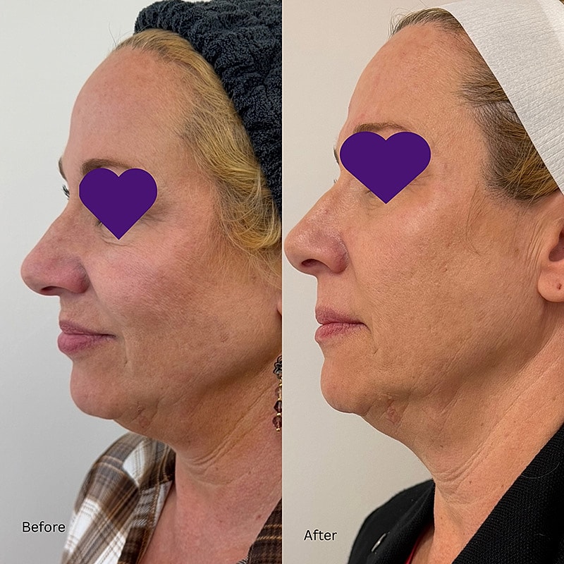 Laser & Energy Before & After