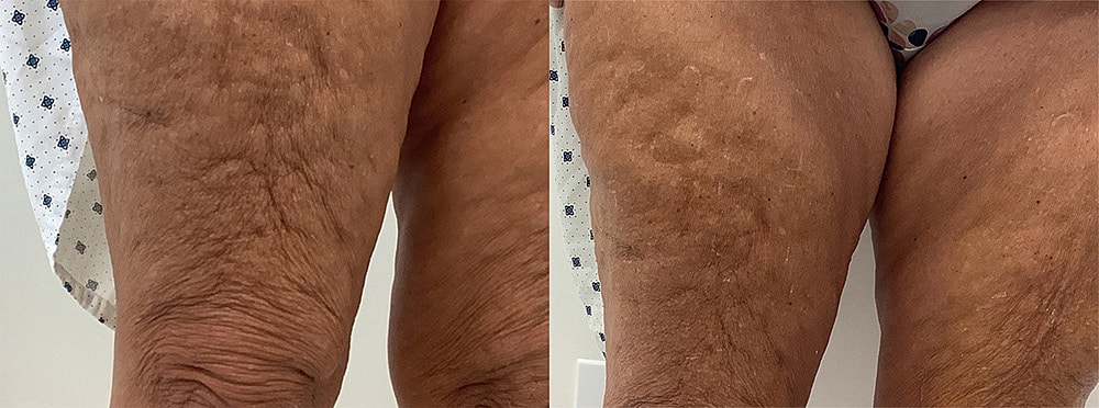 Laser & Energy Before & After