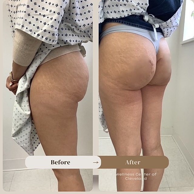 Aveli Before & After