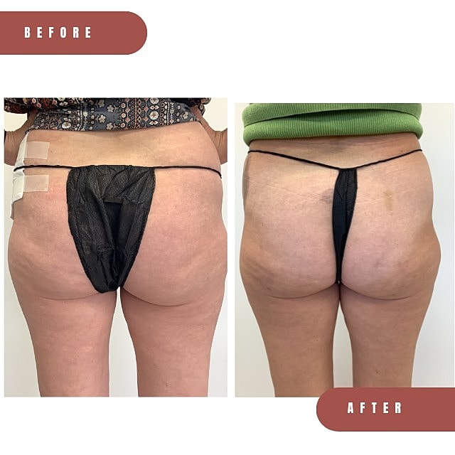 Aveli Before & After