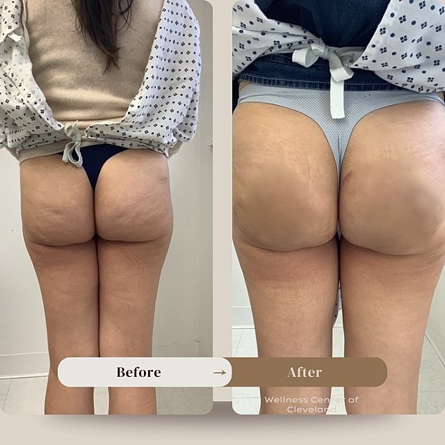 Aveli Before & After