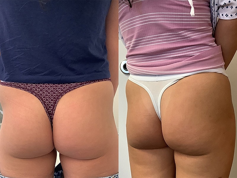 Non Surgical BBL Before & After