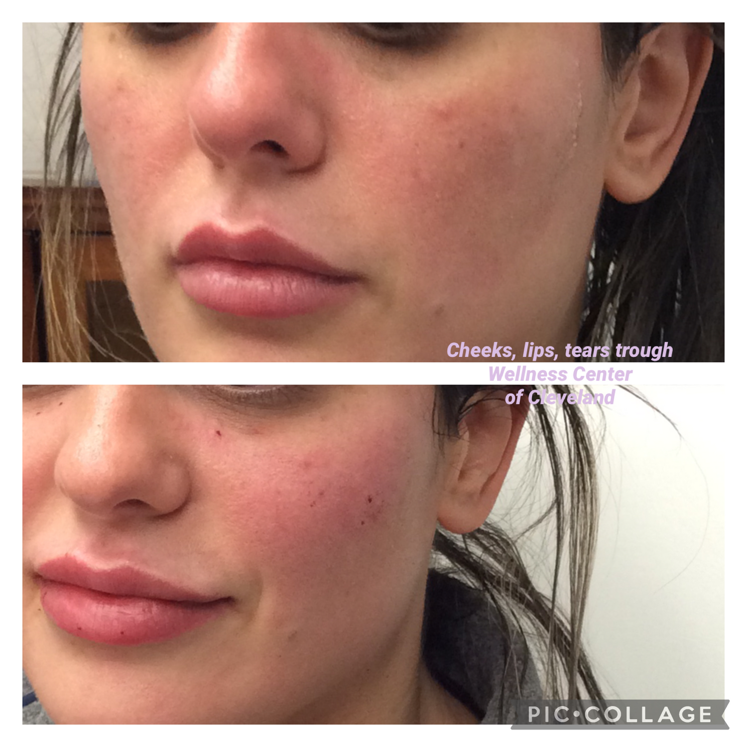 Tear Trough Filler Before & After