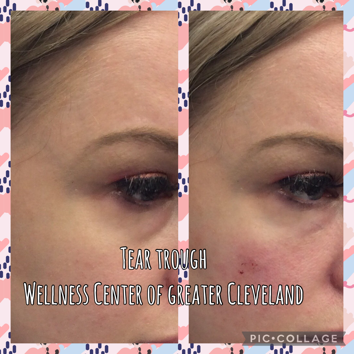 Tear Trough Filler Before & After