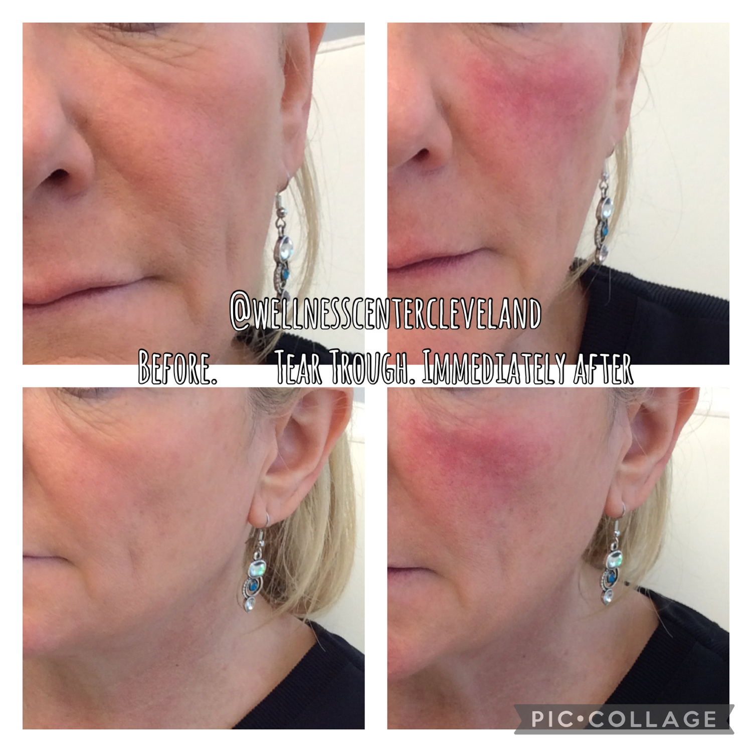 Tear Trough Filler Before & After