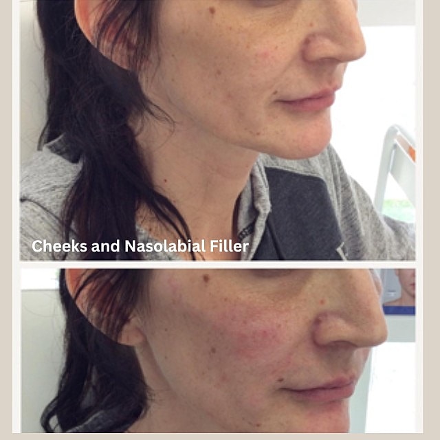 Tear Trough Filler Before & After