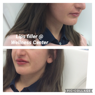 Before and After Photos Before & After