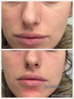 Before and After Photos Before & After