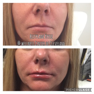 Before and After Photos Before & After