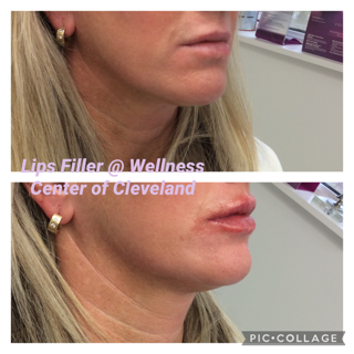 Before and After Photos Before & After