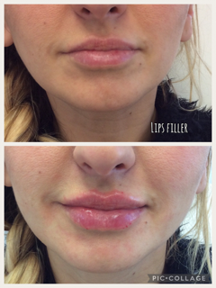 Before and After Photos Before & After