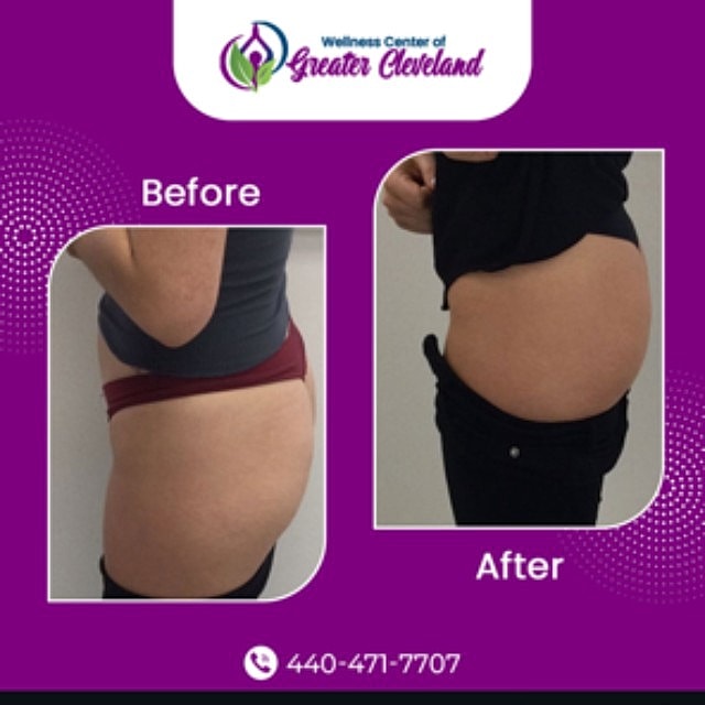 Emsculpt Before & After