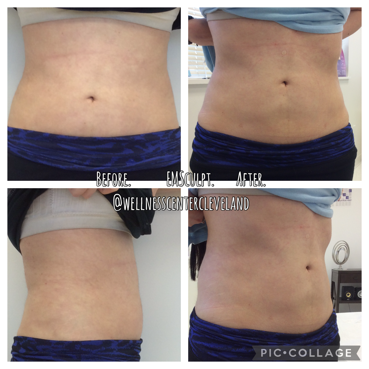Emsculpt Before & After