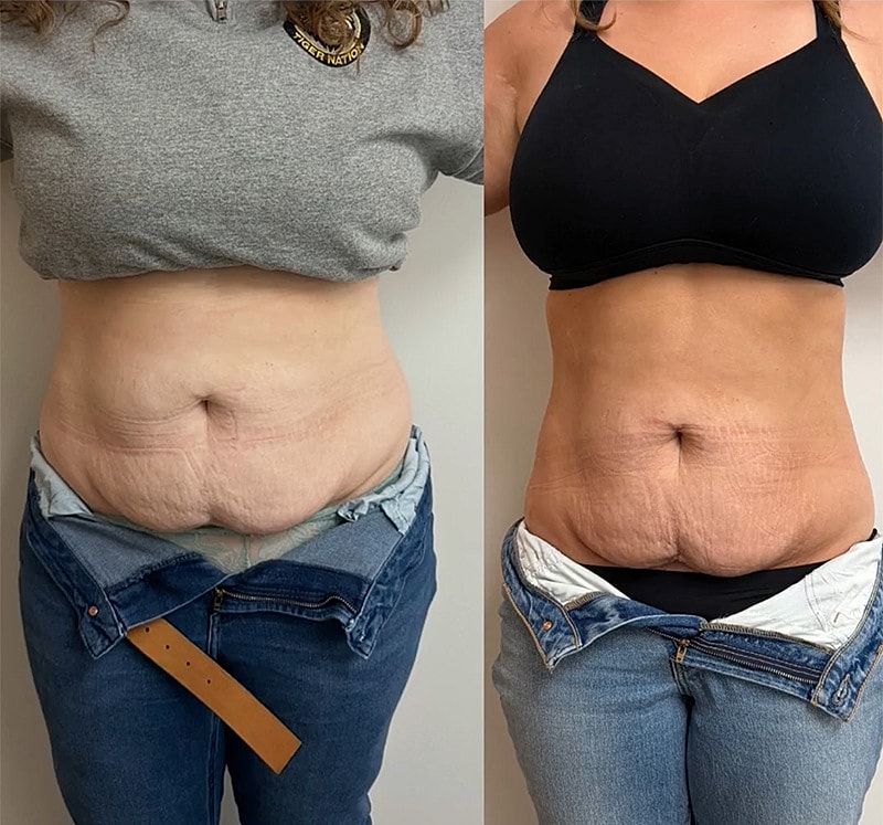 Onda Coolwave Before & After
