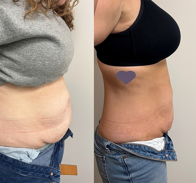 Onda Coolwave Before & After