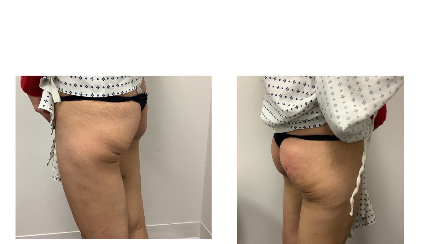 Sculptra BBL Before & After