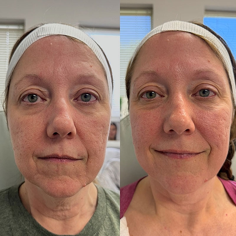 Microneedling Before & After