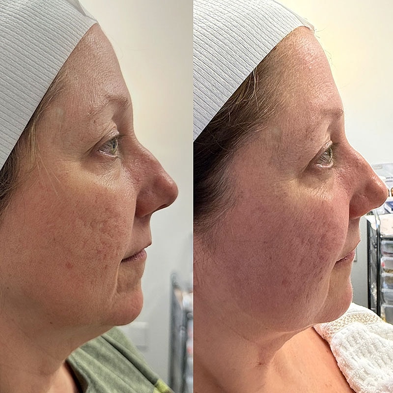 Microneedling Before & After