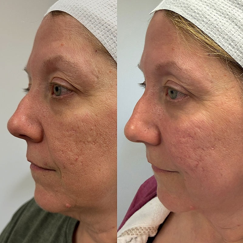 Microneedling Before & After