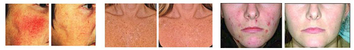 Spectrum IPL Laser Treatment Before and After Near Me in Cleveland OH