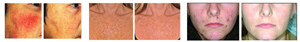 Spectrum IPL Laser Treatment Before and After Near Me in Cleveland OH