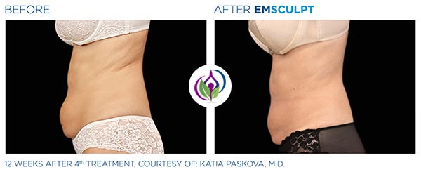 EmSculpt Before and After in Cleveland, OH