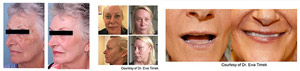 Spectrum IPL Laser Treatment Before and After in Cleveland OH