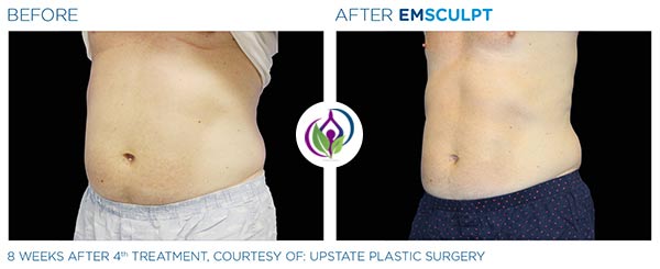 EmSculpt Before and After in Cleveland, OH