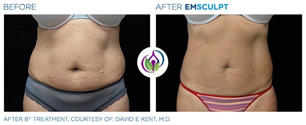 EmSculpt Before and After in Cleveland, OH