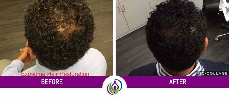 Before and After Photos of MedSpa Clients in Cleveland Ohio