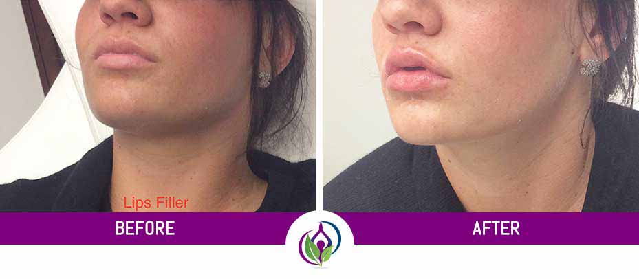 Before and After Photos of MedSpa Clients in Cleveland Ohio