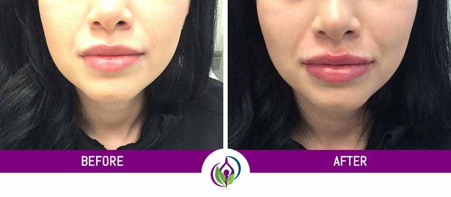 Before and After Photos of MedSpa Clients in Cleveland Ohio