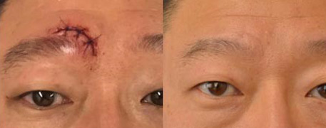 Pixel8-RF Microneedling Treatment Before and After in Cleveland, OH