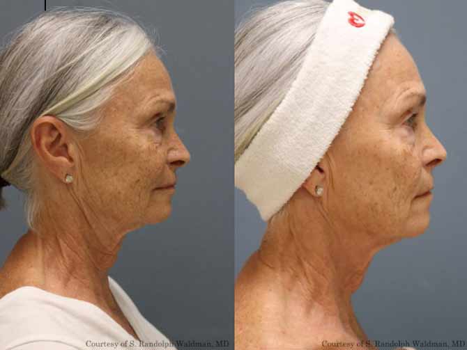 Pixel8-RF Microneedling Treatment Before and After in Cleveland, OH